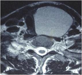 Isolated enteric cysts are neither connected to nervous system nor associated with vertebral abnormalities like neuroenteric cysts, both being histologically the same.