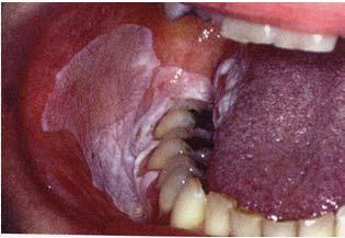 ETIOLOGIC AGENTS Tobacco products Alcohol Viruses (Particularly HPV) Others THE ORAL CAVITY The Oral Cavity is one of very few body sites conducive to visual inspection thereby offering morphological