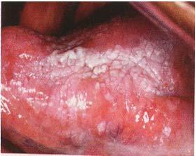Oral cavity is easily accessible for routine clinical examination ORAL CANCER: Missed Diagnosis; Misdiagnosis The incidence of missed diagnosis and misdiagnosis relatively high compared to cancers of
