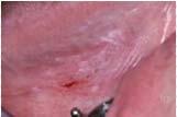 DIAGNOSIC ADJUNCTS: Brush Biopsy Uses small stiff-bristled brush to collect mucosal epithelial cells from a suspicious site Apply firm pressure
