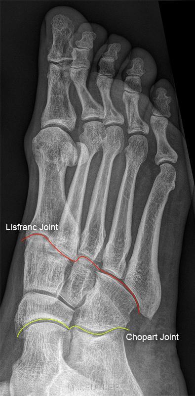 detect on plain radiography. History Jacques Lisfranc (1790-1847) was a field surgeon in Napoleon Bonaparte's army.