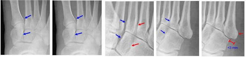 Lateral border of First metatarsal Lateral border of the medial cuneiform Medial border of Second metatarsal Medial border of middle cuneiform Medial and lateral borders of Third metatarsal Medial