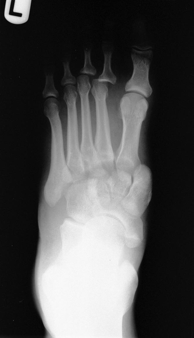 A-P and oblique views showing dislocation of the bases of metatarsals, II-V.