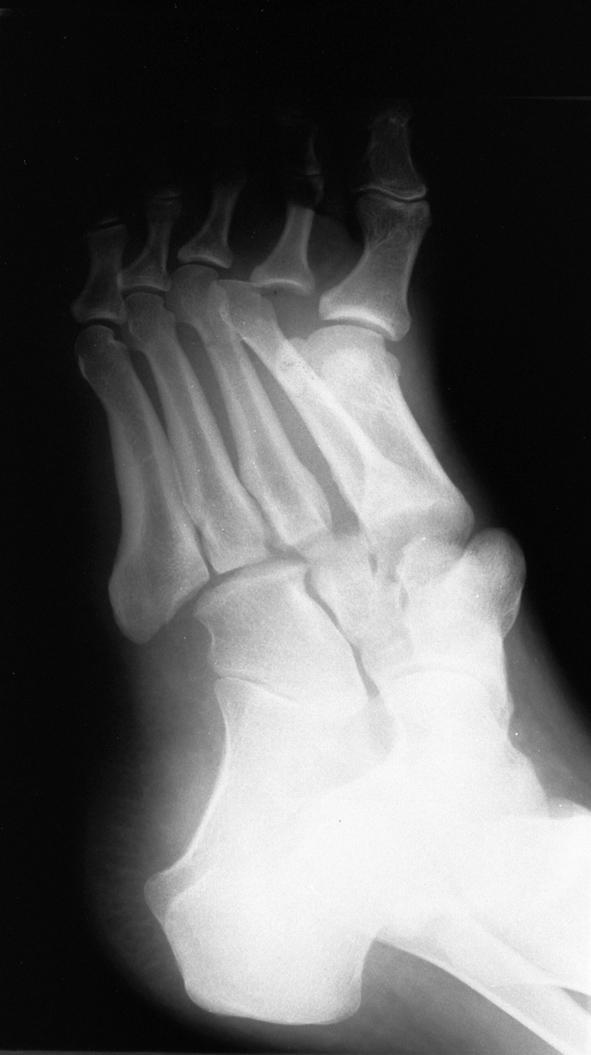 The second x-ray on the right shows confirmatory wide disruption of the second metatarsal on the second view.