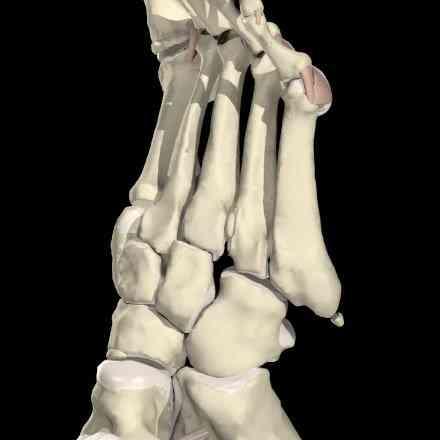 Cuboid Syndrome Subluxation of one of the tarsal bones on the lateral