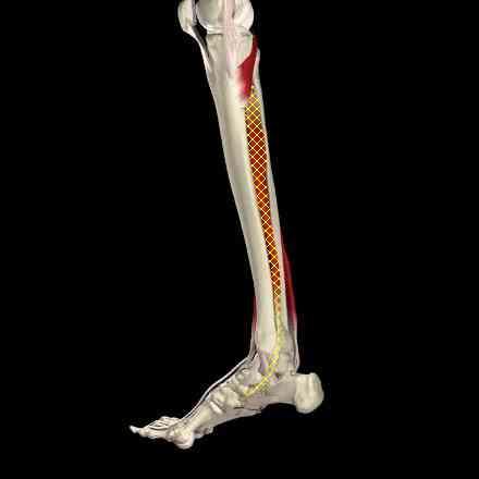 Posterior Tibial Tendonitis Also known as medial shin splint syndrome.