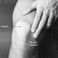 Medial Synovial Plica Syndrome Normal site of pain on the medial side of the knee.