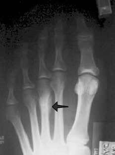 March Fracture (Metatarsal) Stress fracture of one of the metatarsal bones of