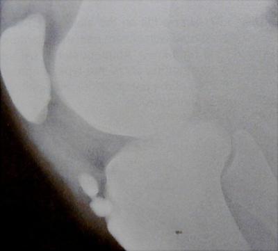 Osgood Schlatter Disease X-ray showing bone damage from osgood schlatter.