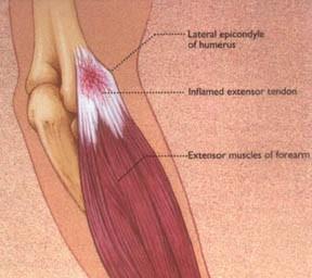 Lateral Epicondylitis Irritation of lateral epicondyle from overuse of supination/extension muscles Most commonly involves extensor carpi radialis longus and brevis Most