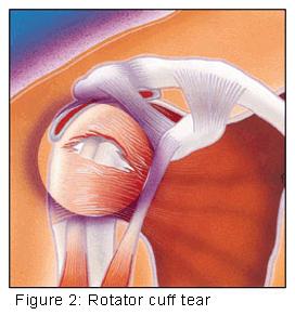 Rotator Cuff Muscles Infraspinatus, teres minor & supraspinatus Subscapularis These muscles are