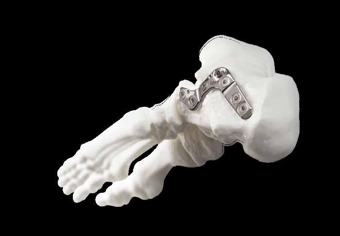 Tornier WAVE Calcaneal fracture plate system surgical procedure Indications for Use: The Tornier Calcaneal Fracture Plate System is indicated for fractures and osteotomies of the calcaneus,