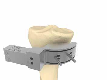 The recut guides are compatible with both slotted standard and MIS tibial cutting blocks.