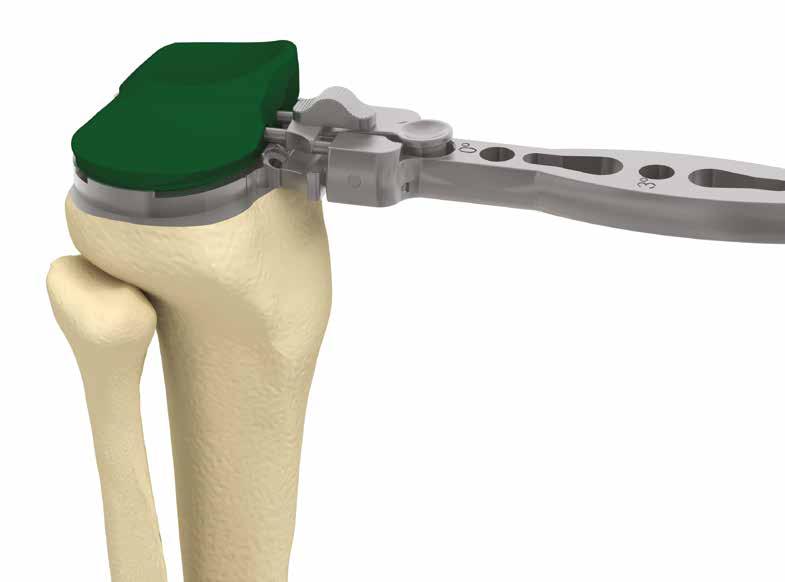 A better option is to perform a trial reduction. The only change that can be made without altering the bone cuts is the thickness of the tibial component.