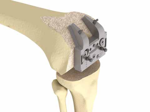 Drill the holes for the femoral pegs through the holes in the distal condyles of the femoral trial.