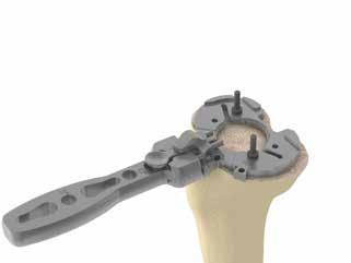 OPTION The femoral box cut can be checked using the manual rasp (ref. 02.02.10.0173). Remove the femoral trochlear cutting/milling guide and lay the rasp on the base of the femoral box.
