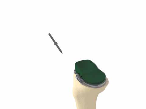 During trials, remove the trial femur before changing the trial insert. Changing the trial insert with the trial femur in place could be difficult due to the shape of the medial compartment. 10.