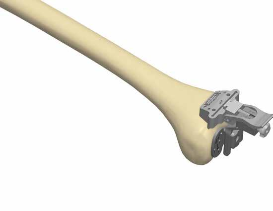 The femoral distal resection, planned at 9 mm (corresponding to the thickness of the distal condyles of the femoral component), can be adjusted later on by moving the cutting block on the pins.