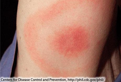 Babesiosis Spotted Fever Rickettsiosis: