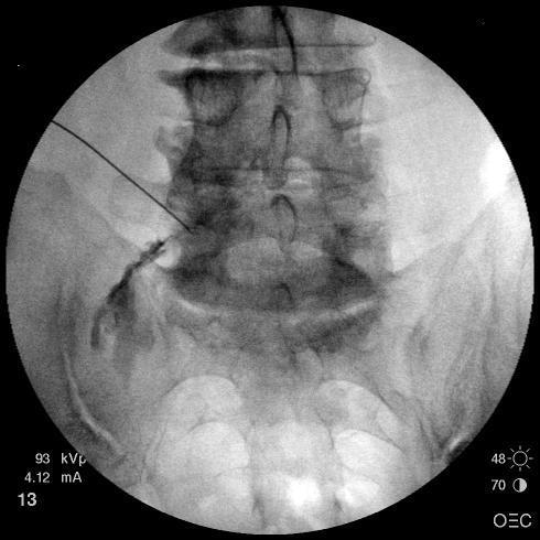 Interventional Pain Management Epidural steroid injection Short term benefit Radicular pain Spinal stenosis No