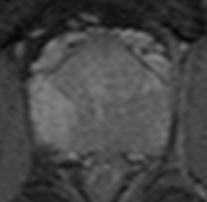 GLAND - MRI