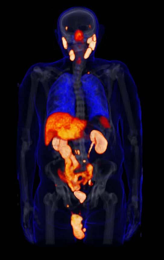PyL: PET/CT IMAGING AGENT PET Radiopharmaceutical product candidate targeting PSMA In-licensed from Johns Hopkins University PSMA Targeting Enables visualization of