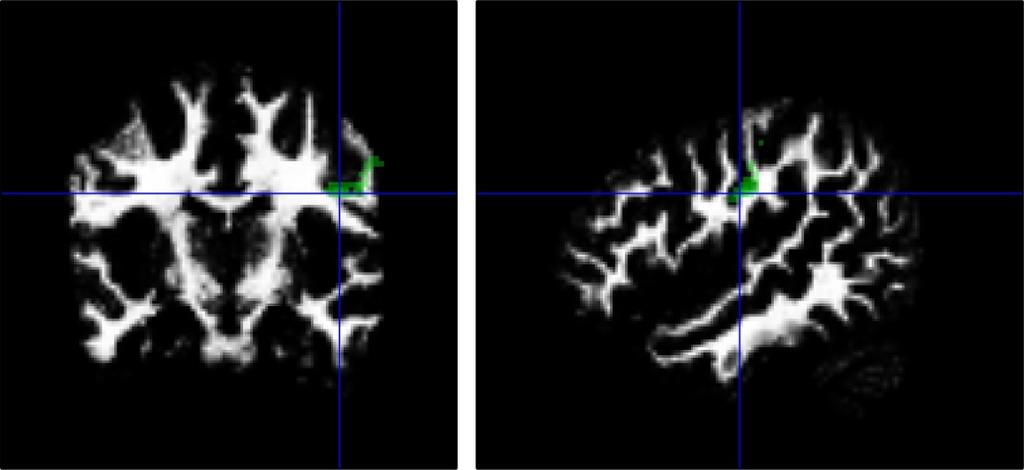 Coronal and sagittal views of voxels with a significant decrease in fractional anisotropy in the right anterior parietal lobe and postcentral gyrus g (P <.