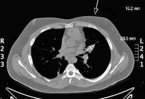 multiple new pulmonary nodules 2004 (at age 12) -> right arm mass resected in China 2005 recurrence -> re-resection + RT in China 5/06 CT chest (in US) -> LLL nodule 6/06 resection LLL nodule ->