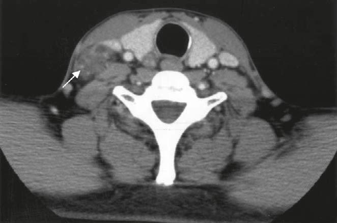 () Case 2: branchial cyst and two cystic metastatic lymph nodes from papillary thyroid carcinoma.