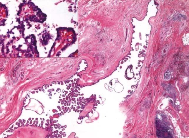 H.S. Chi, L.F. Wang, F.Y. Chiang, et al Figure 3. () Case 1: a cystic lesion with complicated papillary projections within a lymph node is shown (original magnification, 20 ).