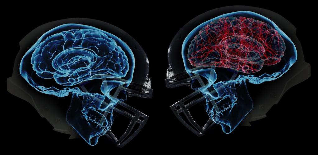 NEUROFEEDBACK INNOVATIONS FOR CONCUSSION WITH RETIRED NFL PLAYERS 4/1/17 Evaluating the Effectiveness of Ultra Low Power Pulsed Electric Current EEG Biofeedback in Treating Symptoms of Repeated