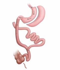 Some procedures, such as gastric bypass, use both. Some are performed using keyhole surgery, while others require open surgery.
