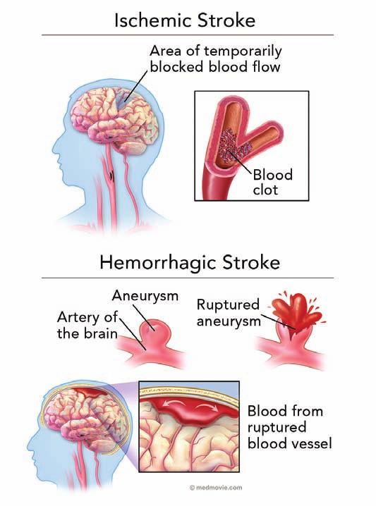 Stroke: What is it? Stroke is a brai ijury that causes various problems, depedig o the area of the brai that is affected.