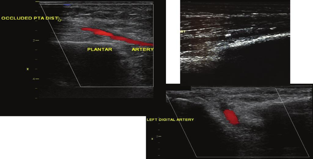 You can see this at the level of the lateral plantar artery.