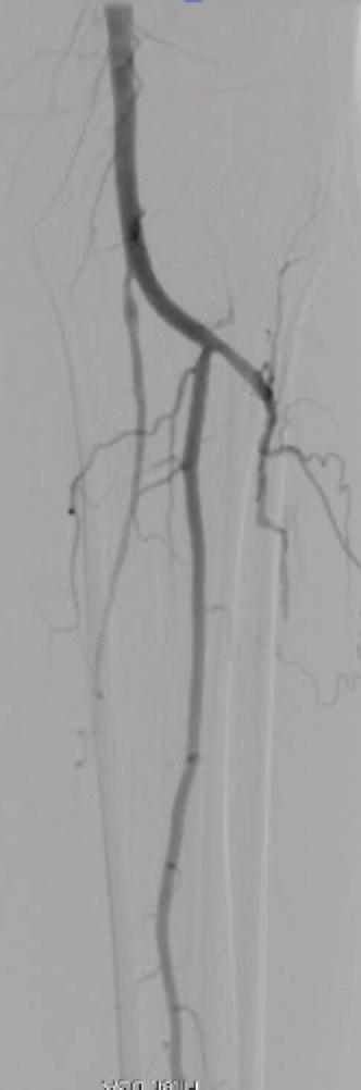 ACCESSING OCCLUDED ARTERIES Gaining access to an occluded artery can be very helpful when there is a long occlusion with a distal reconstitution site that is difficult to approach.