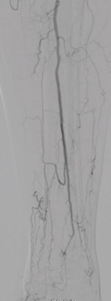 occluded stents. It can be done in the tibial vessels as well but is much more technically challenging.