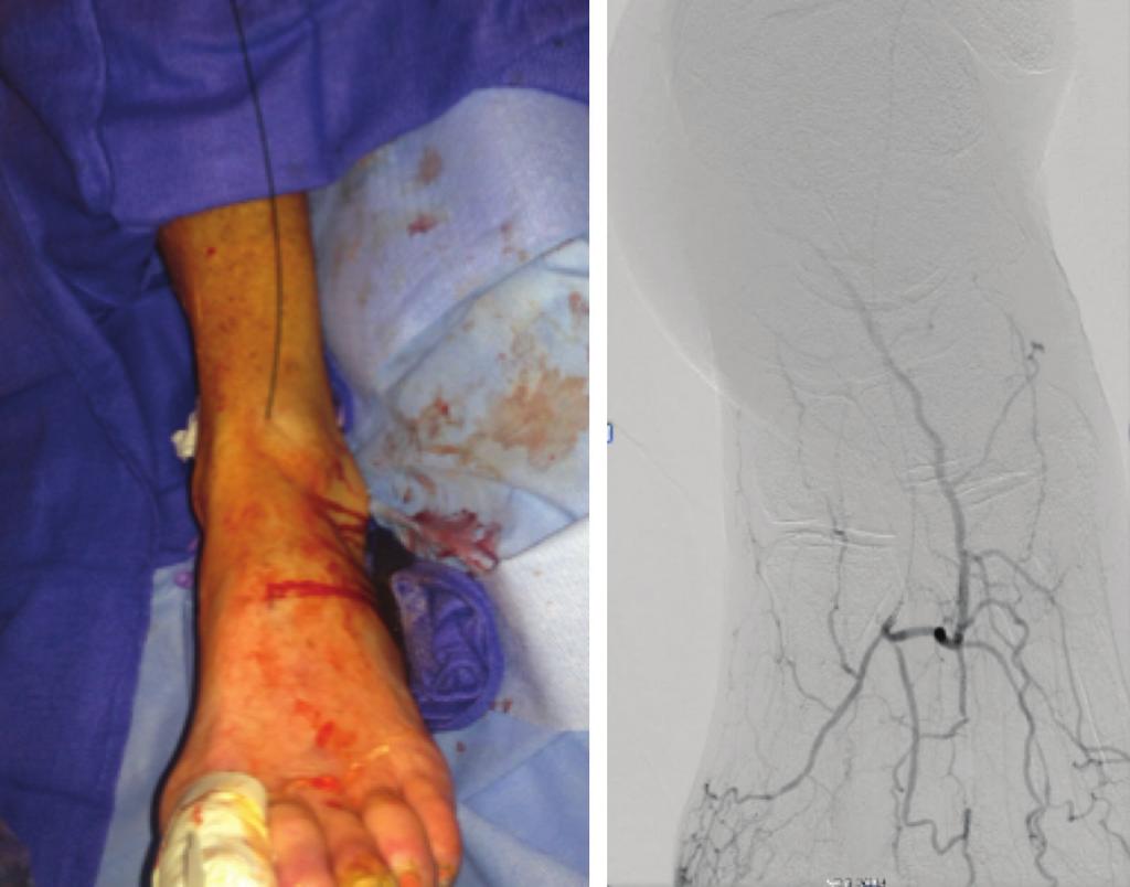 CASE REPORT Figure 4. A wire loop technique was used and maintained while crossing the occlusion in the lateral plantar artery.