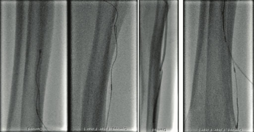 3 Anterior tibial access was achieved via an occluded anterior tibial vessel.