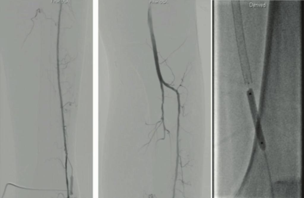 level of the common plantar artery with rest pain. We brought her back and opened this vessel again.