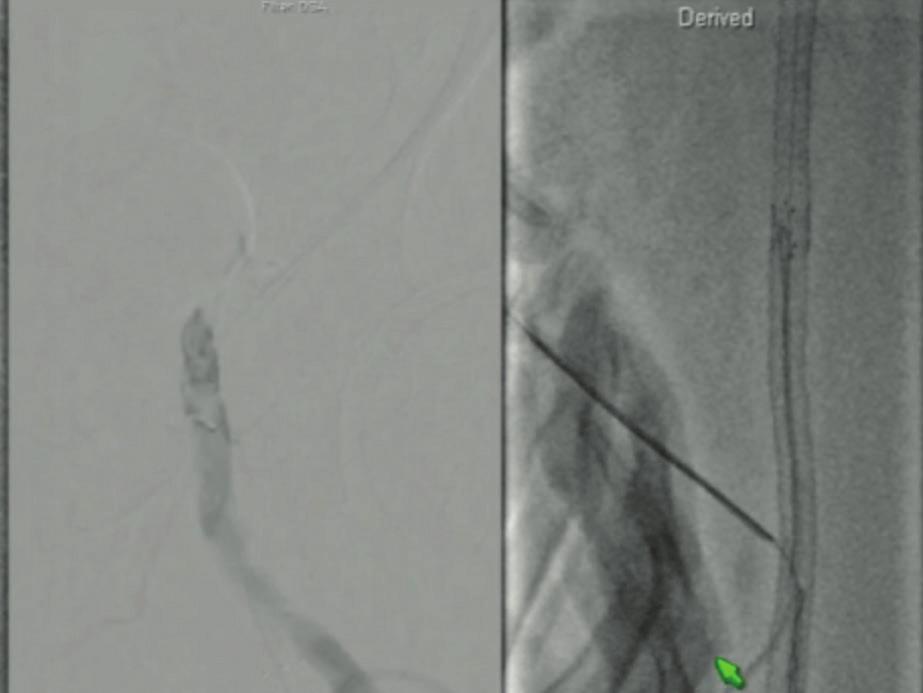A confirmation angiogram was taken to confirm placement. Antegrade access of the SFA was then performed, and both retrograde and antegrade wires can be seen in the images. pain.