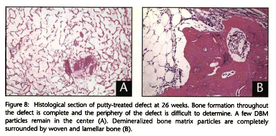 Demineralized bone matrix (DBM) Acid extraction of allogenic bone Removes inorganic material, Collagen I framework exposed
