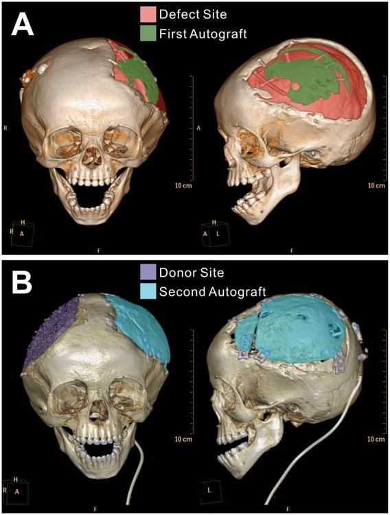 Repair of extensive defects Extensive defects prevent spontanous re-ossification Autologous bone grafts: Cranium