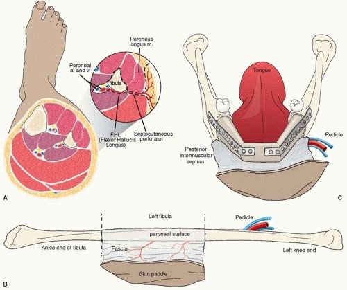 Autologous bone transplants Fibula flap https://plasticsurgery