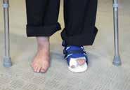 You should walk with the foot flat on the floor and take short steps stepping to the other leg putting most of the weight through the heel and avoiding putting weight through the toes.