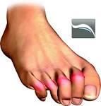 Abnormalities associated with the metatarsophalangeal (MTP) joints include hallux valgus of the first MTP joint and instability of the lesser MTP joints, especially the second toe.