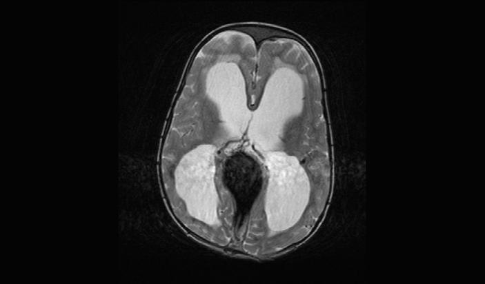 Figure 1. T2 weighted spin echo MR image showing supratentorial midline cystic mass lesion showing signal void on SE sequences and communicating with the dilated straight sinus.