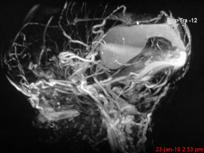 Figure 3. MR angiography showing VOGM and numerous associated intracranial vascular malformations.