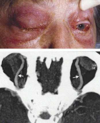 Cavernous sinus septic intracranial thrombosis Bilateral spread within 24-48 hours through anterior and posterior inter-cavernous sinuses Direct spread to other dural sinuses and