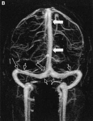Septic intracranial thrombosis Superior sagittal sinus