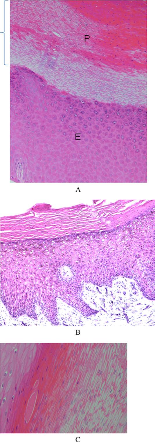8 J Am Coll Surg Figure 2. (A) Dermal fibrosis characterized by acellular strands of woven collagen.